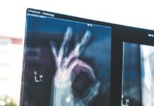 골다공증 예방, 튼튼한 뼈 건강을 위한 생활 속 실천법 citiscan result hand ok